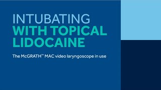 Intubation with Topical Lidocaine and McGrath™ MAC video Laryngoscope [upl. by Alehcim]