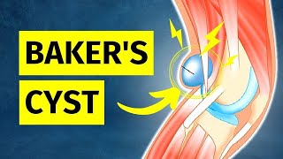 How to ACTUALLY Treat a Bakers Cyst Pain Behind Knee [upl. by Agarhs]