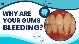 Bleeding Gums Why Do Gums Bleed Causes You Should Know [upl. by Latreese]