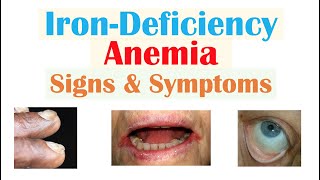 IronDeficiency Anemia Signs amp Symptoms ex Fatigue “Spoon Nails” Cracked Lips [upl. by Ardnosac]