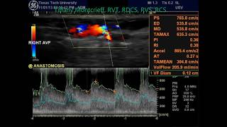 Radialcephalic Arteriovenous Fistula Duplex Evaluation AVF [upl. by Kristofer]