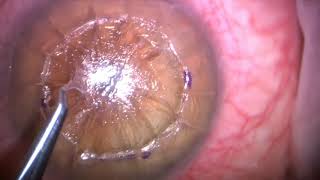 Gulani Academy Radial Keratotomy Corrective Series Corneal Surgical Artistry Corneoplastique [upl. by Tye417]