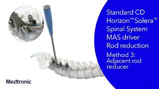 CD Horizon™ Solera™ Spinal System  Dual Rod MultiAxial Screw DRMAS amp Variable Angle Domino VAD [upl. by Adamok268]