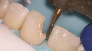 Teeth Bonding  Front tooth filling EXPLAINED [upl. by Notsehc]