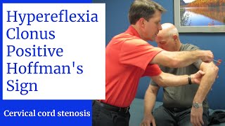 Hyperreflexia Clonus Positive Hoffmans Sign Central Cervical Spine Stenosis [upl. by Naor824]