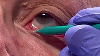 Mitomycin releasing plug for lacrimal punctal stenosis [upl. by Bonaparte]