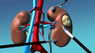 Robotic Partial Nephrectomy Animation [upl. by Irrok]