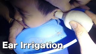 5 Year Old Boys Earwax Removal by Ear Irrigation [upl. by Parry780]