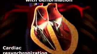 Resynchronizationdefibrillation for heart failure [upl. by Ahsoem]