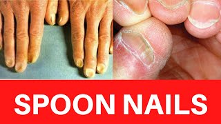 SPOON NAILS  Koilonychia Causes Treatment Symptoms Iron deficiency Anemia Cure Prevention [upl. by Chelsie]