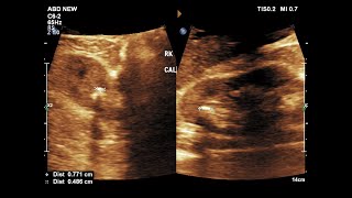 Nephrolithiasis  Renal Calculi  Ultrasound  Case 08 [upl. by Ymeraj]