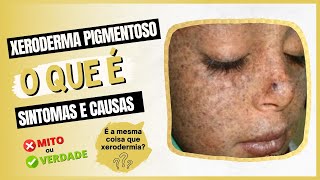 Xeroderma Pigmentoso  O que é sintomas e causas [upl. by Idak]