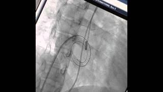 How to do a Percutaneous Transvenous Mitral Commissurotomy PTMC Dr Binoy John COMPLETE STEPS [upl. by Goulden]