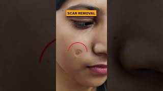 Scar Removal Treatment in Delhi  Scar removal results before and after scar scarremoval scars [upl. by Eerac]