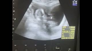 Bicornuate uterus 14wks pregnancy Diagnostic ultrasound cases [upl. by Demaggio]