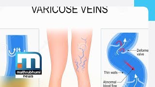 Varicose Veins Symptoms And Treatment Doctor 2PM Part 1 [upl. by Francklin447]