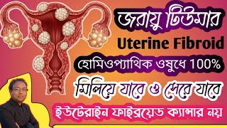 Uterine fibroid homoeopathic medicine  fibroid tumor homoeopathic medicine  jaraur tumor [upl. by Heringer]