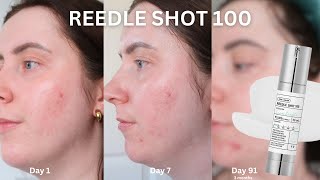 30 Days OfVT Cosmetics Reedle Shot 100  3 MONTH UPDATE [upl. by Galer]