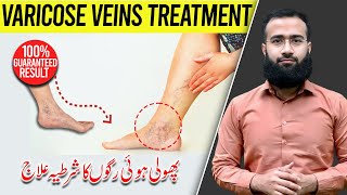 Varicose Veins Treatment  Spider Veins Exercises  Permanent Results [upl. by Mathis900]