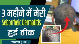 3 महीने में मेरी Seborrheic Dermatitis हुई ठीक  फिरोज  My Oily Dandruff Cured  Feroz [upl. by Illona832]