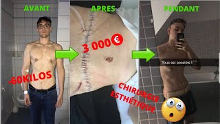 Abdominoplastie AVANTAPRÈS Mon histoire [upl. by Ute]