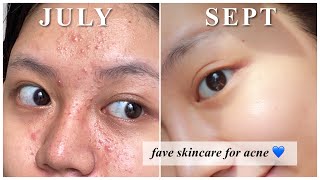 Rekomendasi Skincare utk Jerawat kombinasi berminyak [upl. by Aihgn]