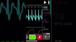 PSVT CardioversionDefibrillation [upl. by Curson]