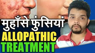 Acne Pimples Treatment in hindi [upl. by Ainesej]