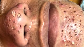 Blackhead Removal With Sac Dep Spa 1000363 [upl. by Ariadne85]