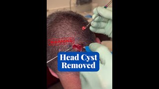 Cyst located on head EXTRACTED CONTOUR DERMATOLOGY [upl. by Krista]