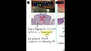 Papillae Vs Follicles in Conjunctiva  Histopathology Shorts [upl. by Gans]