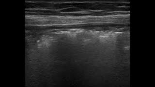 Pneumatosis intestianalis ultrasound Bowel ultrasound 032022 [upl. by Kissie]