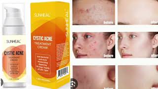 SUNHEAL CYSTIC ACNE TREATMENT CREAM [upl. by Olodort295]