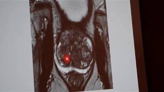 Prostate MRI A whole new look at prostate cancer [upl. by Ydnor]