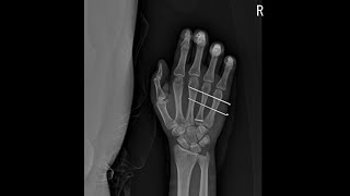 4th metacarpal base fracture [upl. by Nira]