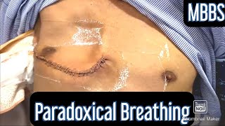 Paradoxical Breathing mbbs medicine neetpg usmle inicet [upl. by Ecidnacal]