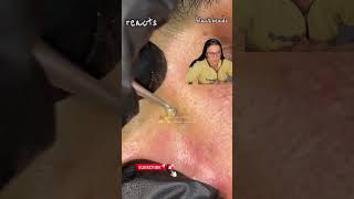 blackheads nose blackheads nose removal blackheads nose extraction blackheads nose tweezers [upl. by Jews]