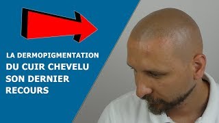 La Dermopigmentation du cuir chevelu son dernier recours [upl. by Nofets]