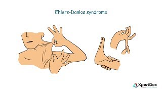 What is Ehlers Danlos Syndrome [upl. by Suoivatco]