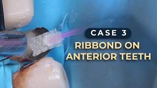 How to save anterior teeth with Ribbond amp Emax Crowns  Case 3 [upl. by Lazar104]