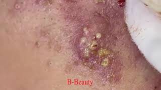 Pimple Removal and Acnes Treatment  BBeauty 07 [upl. by Obocaj]