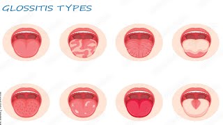 Glossitis benign migratory glossitis geographic tongue [upl. by Orling]