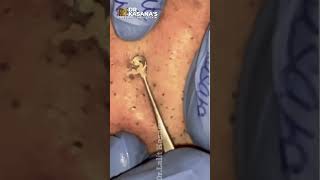 Best of Blackheads Removal by Dr Lalit Kasana [upl. by Ecnerolf]