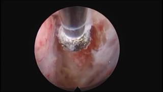 C12 Rheumatoid Pannus arthritis endoscopic decompression [upl. by Alul483]