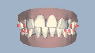 INVISALIGN CLINCHECK PROGRAM PATIENT TREATMENT DEMONSTRATION 1 [upl. by Ynnal915]