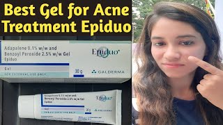 Epiduo Gel for acne amp acne scars  Gel to get rid of pimples  Best cream for acne treatment at home [upl. by Wynne900]