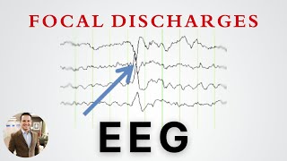 Focal Discharges on EEG and what they mean in Epilepsy [upl. by Kola514]