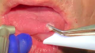 Fibroma Removal Without Local Anesthetic [upl. by Amhser]