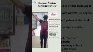 Ligament tear Patient testimonial DrLRakesh MD Panchakarma [upl. by Eciral]