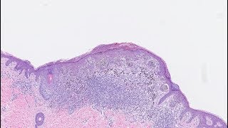 Study examines accuracy of melanoma biopsy findings [upl. by Cyrie]